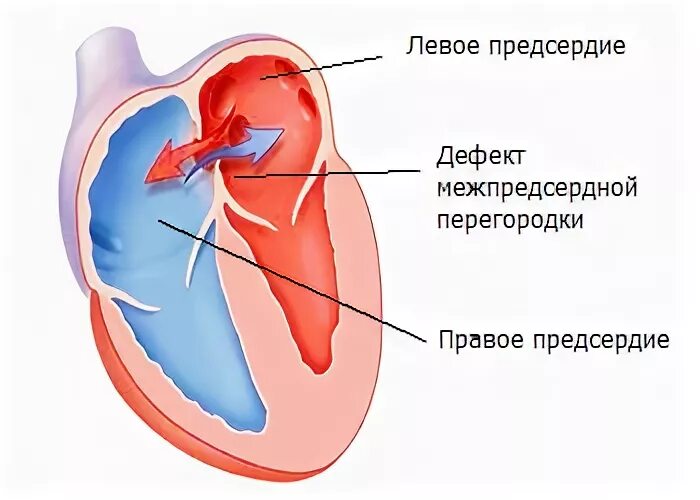 Окно в сердце у ребенка