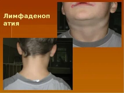 Генерализованная лимфаденопатия