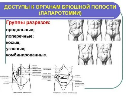 Лапаротомия брюшной полости