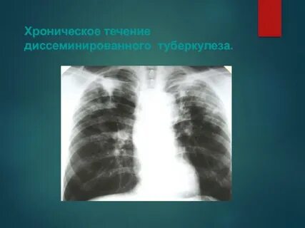 Поражение легких