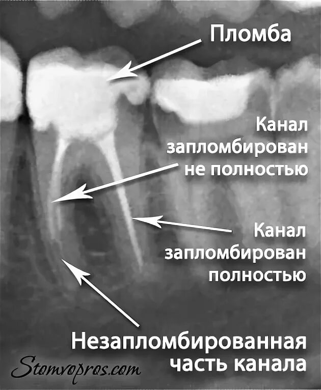 This Patient Chose Orthograde Endodontic Revision Procedure on his Mandibular Pr