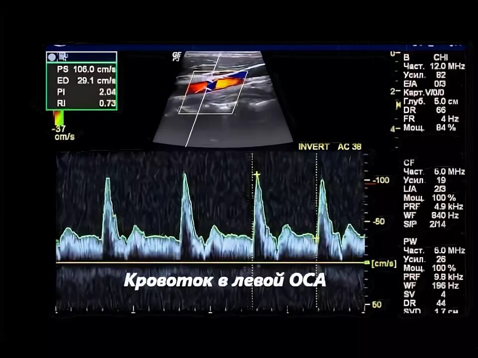 Диссекция вса мрт. Узи бца норма. Стеноз сонной артерии уздг. Узи брахиоцефальных стволов. Цдс бца.