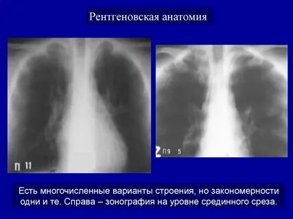 Зонография