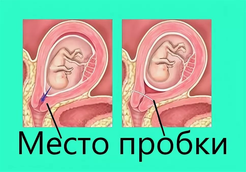 Схватки и отхождение пробки. Пробка при беременности. Отходит пробка перед родами. Шейка матки при беременности пробка.