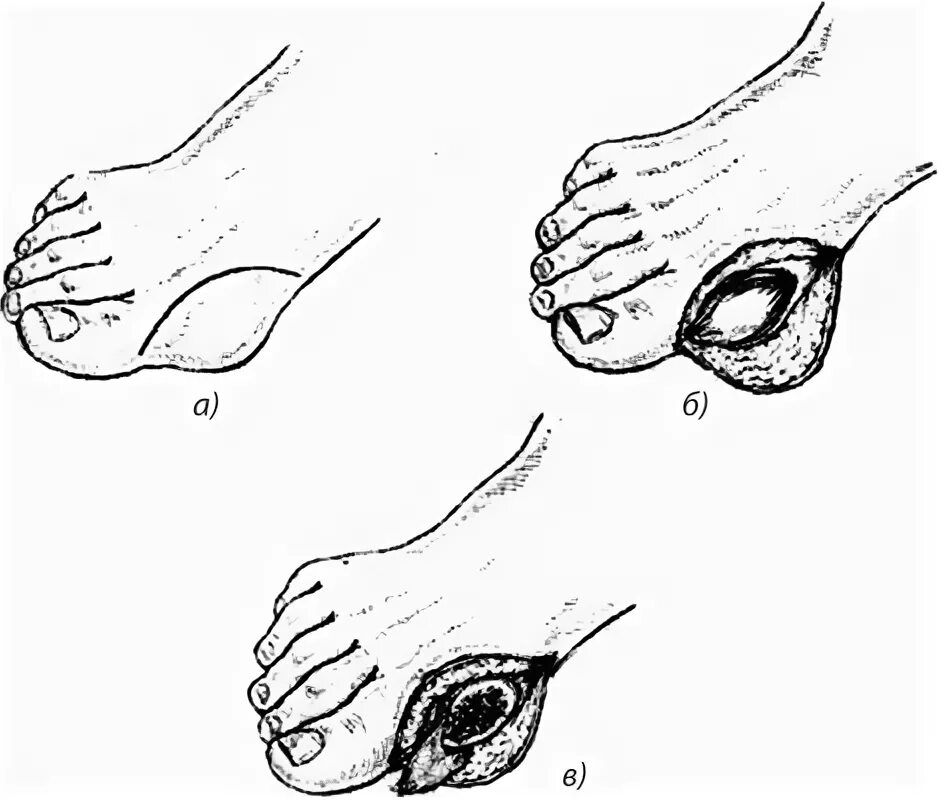 Операция типа шеде— брандеса. Корригирующая остеотомия 1 плюсневой кости. Операция шеде. Операция шеде. Остеотомия при вальгусная деформация.