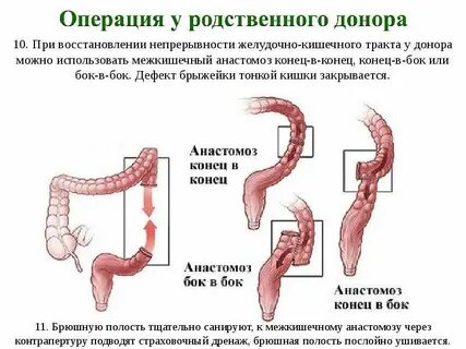 Сколько идет операция на кишечнике