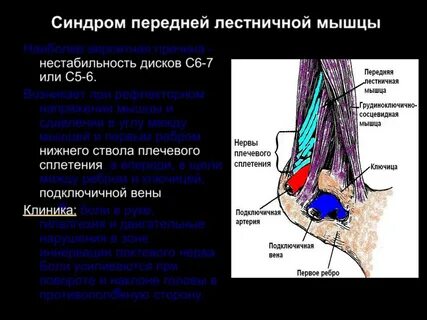 Синдром лестничной мышцы