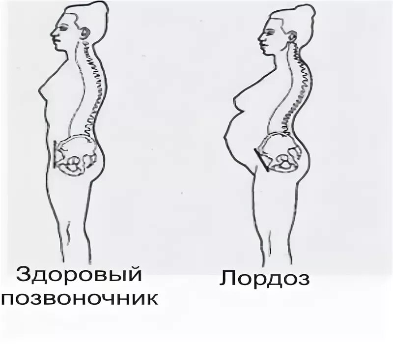 Лордоз поясничного отдела и гиперлордоз. Лордоз с3- с7. Лордоз тазобедренного сустава. Гиперлордоз поясничного отдела позвоночника живот.