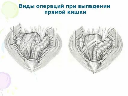 Выпадение слизистой кишки