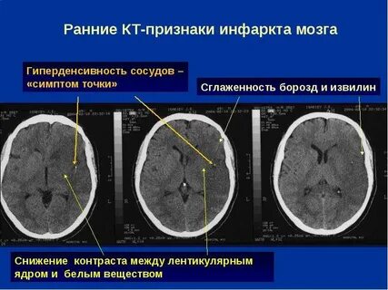 Кт показывает инсульт