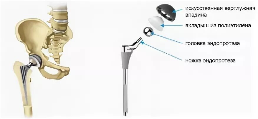 Эндопротез тазобедренного сустава DEPUY. Эндопротез тазобедренный Stryker v40tm. Эндопротезирование тазобедренного сустава операция. Эндопротез тазобедренного сустава строение. Осложнения после эндопротезирования тазобедренного сустава