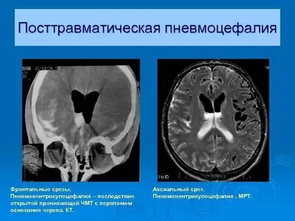 Пневмоцефалия