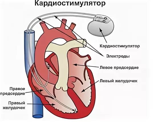Сколько живут с кардиостимулятором. Кардиостимулятор сердца. Эхо кг с кардиостимулятором. Кардиостимулятор операция. Имплантация кардиостимулятора.