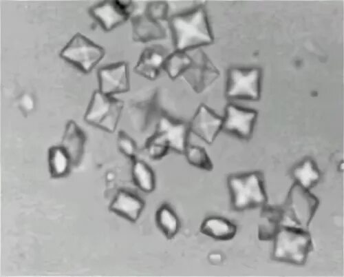 Кристаллы оксалата в моче у мужчин. Оксалаты кальция в моче микроскопия. Кристаллы оксалата кальция. Оксалат кальция под микроскопом. Кристаллы оксалата кальция в моче.