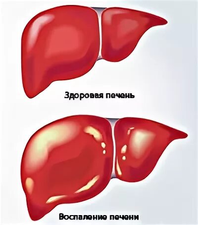 Реактивная печень