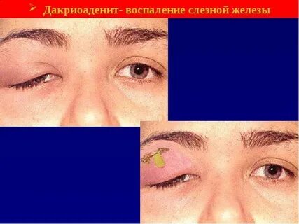 Дакриоденит