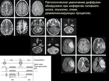 Мрт диффузия всего тела онкологический скрининг