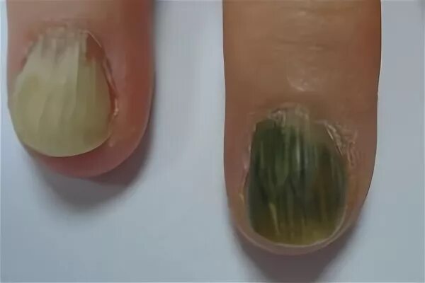 Синегнойная палочка на ногтях. Отодвигание кутикулы апельсиновой палочкой. Ногтевая палочка. Палочка для кутикулы. Апельсиновая палочка для ногтей.