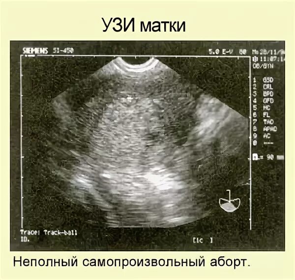 Беременность после самопроизвольного. УЗИ при неполном выкидыше. Матка при беременности на ранних на УЗИ. Матка беременной женщины на ранних сроках УЗИ.