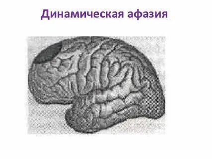 Динамическая афазия
