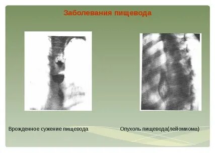 Заболеваемость пищевода