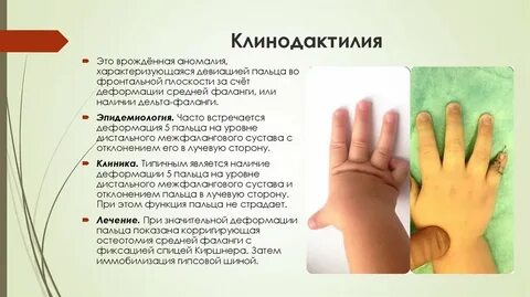 Аномалии в развитии кисти псевдоаутосомный