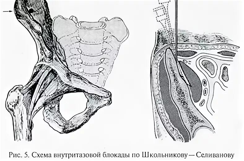 Блокада по Школьникову-Селиванову техника. Внутритазовая блокада по Школьникову-Селиванову. Внутритазовая новокаиновая блокада по Школьникову. Блокада новокаиновая Школьникову Селиванову. Школьникова селиванова