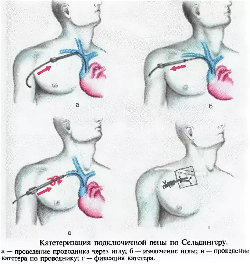 Уход за подключичным катетером