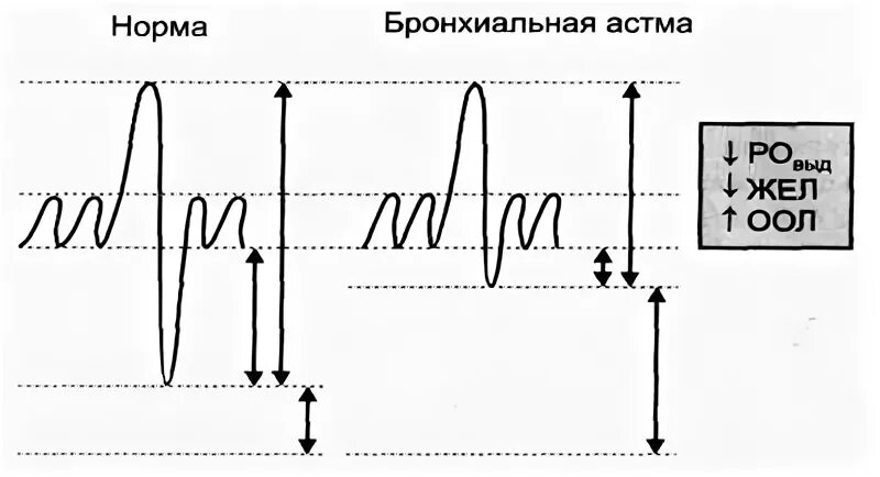 Спирограмма пример. Спирограмма. пневмотахография при бронхиальной астме. график спирометрии при бронхиальной астме.