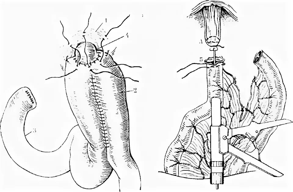 Пищеводно-кишечный анастомоз. Анастомоз пищевода с тонкой кишкой. Гастрэктомия анастомоз.