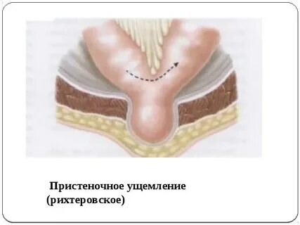 Подкожная грыжа