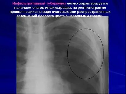 Очаговая инфильтрация левого легкого