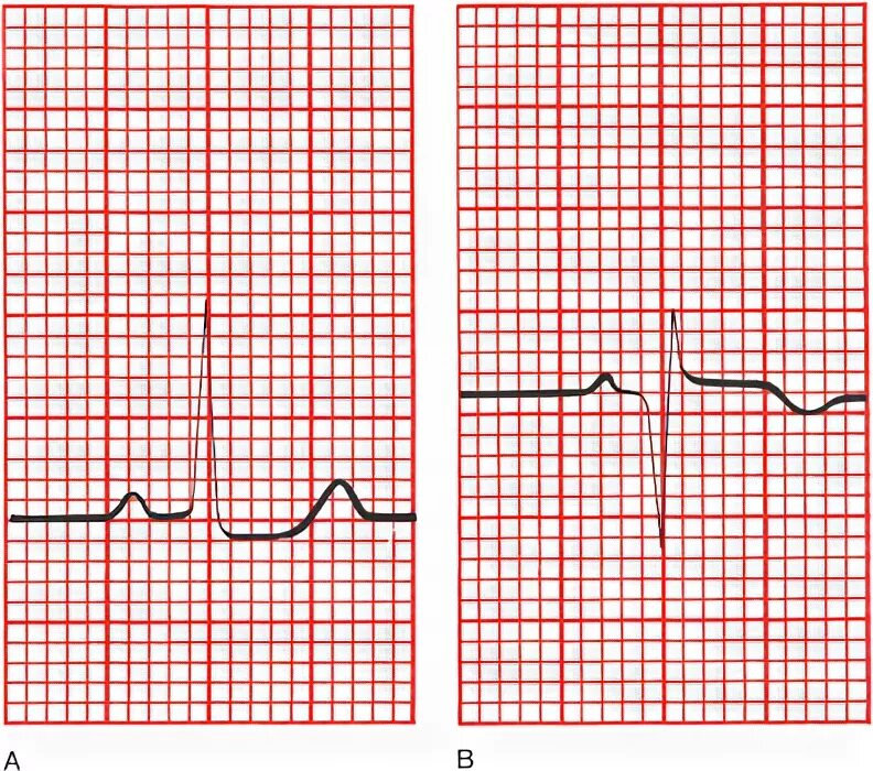 Депрессия st в v4 v5 v6. Элевация сегмента pq на экг. Косонисходящая депрессия сегмента st. Депрессия st v6. Элевация сегмента st в ii, iii, avf.