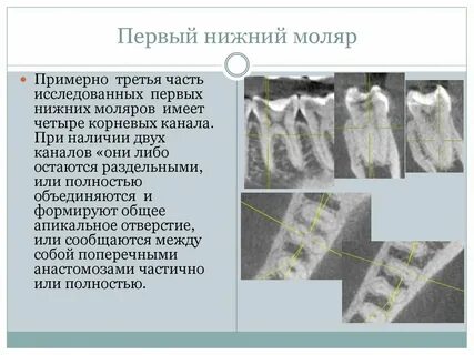 Каналы верхнего моляра