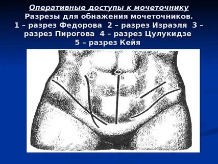 Операция бергмана
