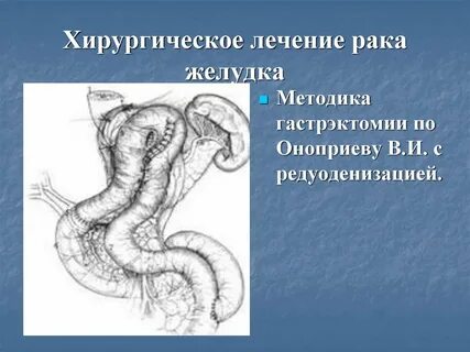 Лечение рака желудка