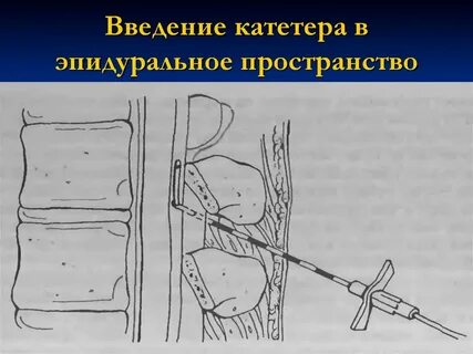 Эпидуральный катетер