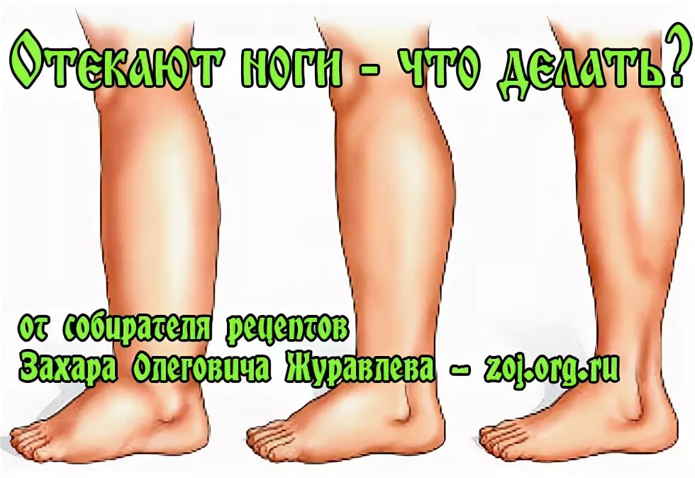 Пастозность нижних конечностей. Отеки ног к вечеру у женщин. Усталость ног. Сильно отекают ноги причина. Отеки ног к вечеру у женщин.