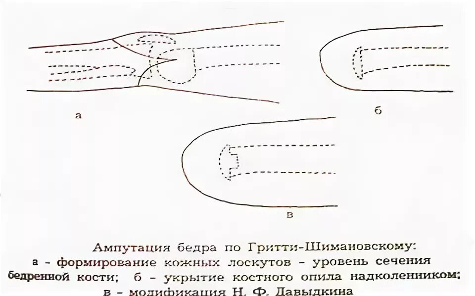 Ампутация бедра по Гритти-Шимановскому. Гильотинная ампутация схема. Костно-пластическая ампутация бедра по Гритти-Шимановскому.