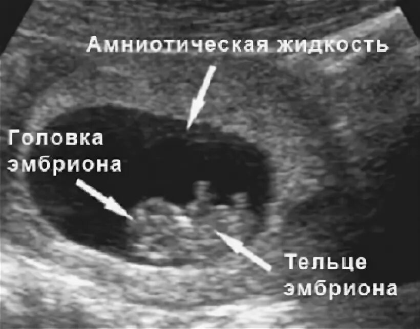 Роды на 7 неделе. УЗИ 7 недель беременности. УЗИ 7 недель беременности фото. Плод на 7 неделе беременности УЗИ. Беременность 7 недель фото эмбриона на УЗИ.