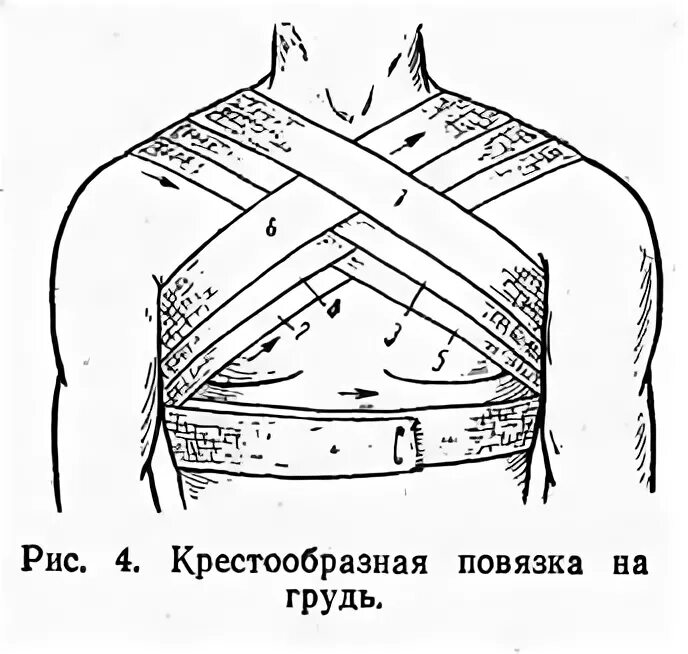 Техника наложения крестообразной повязки. Наложение спиралевидной повязки на грудную клетку. Технику наложения крестообразной повязки на грудную клетку. Десмургия восьмиобразная повязка. Перевязка грудной клетки алгоритм.