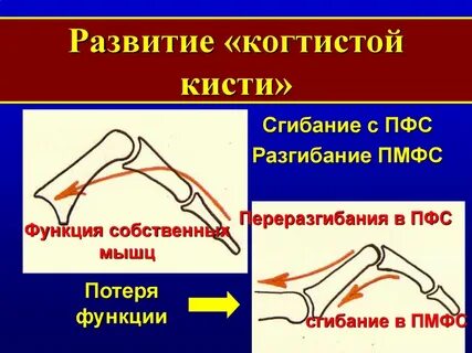 Транспозиция мышцы
