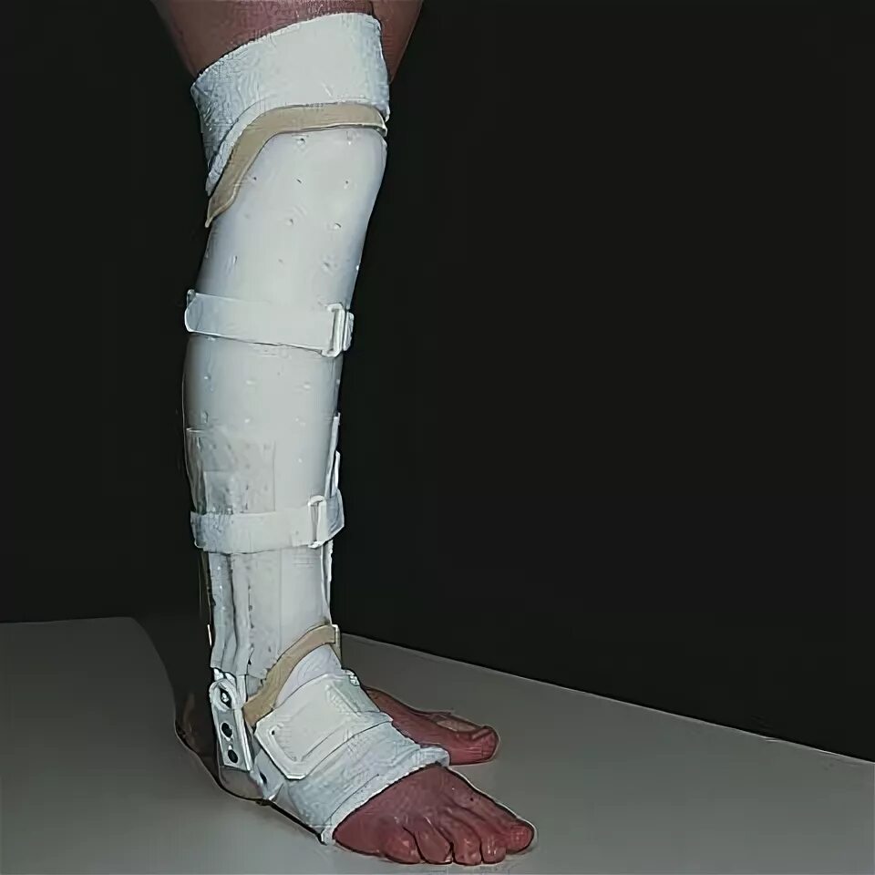 Ортез для ахиллова сухожилия. Ортез малая берцовая кость. Ортез малая берцовая кость. Лангет на голеностопный сустав при переломе. Ортез при переломе большой берцовой кости.