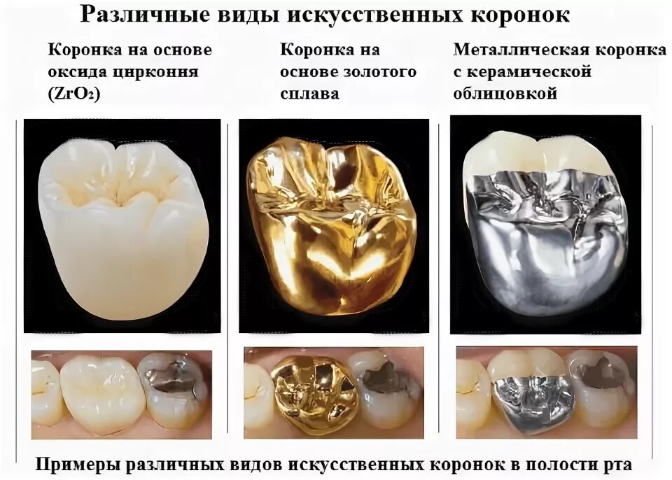 Изготовление и установка металлокерамических коронок Казань