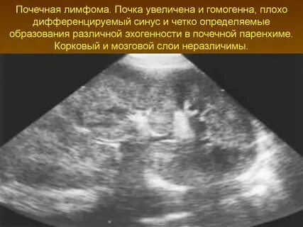 Почему расширены почки
