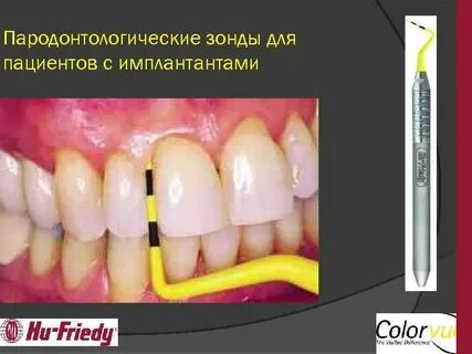 Пародонтальный зонд