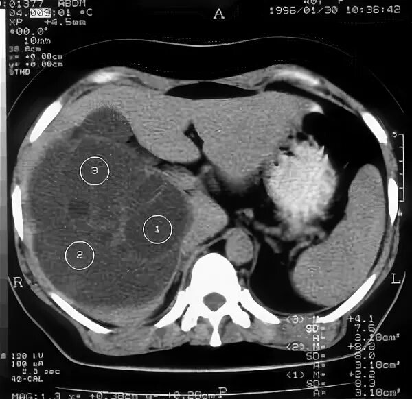 Чем лечить кисту левой доли печени. Альвеококковая киста печени на кт. Кисты печени кт эхинококкоз. Паразитарные кисты печени кт. Множественные кистозные образования печени кт.