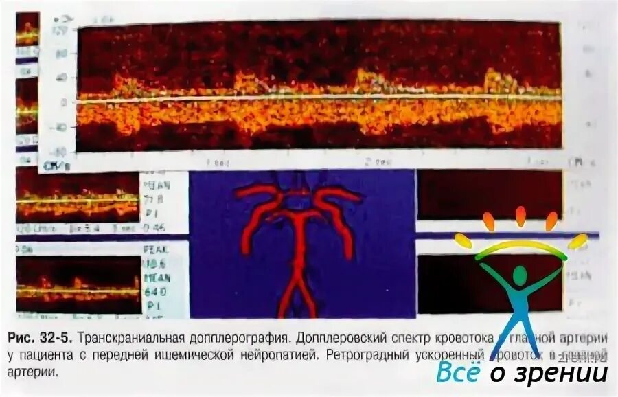 Передняя ишемическая нейропатия