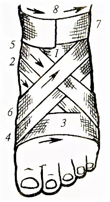 Бинтование стопы по финку Эттингену. Крестообразная восьмиобразная повязка на стопу алгоритм. Бинтование восьмиобразная. Крестообразная (восьмиобразная) повязка на кисть. Какая повязка при повреждении голеностопного сустава