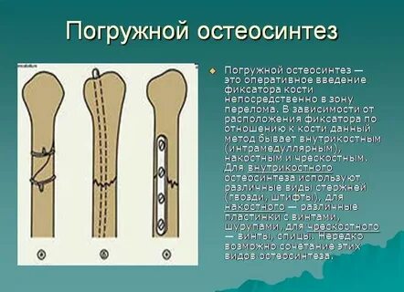 Остеосинтез переломов костей